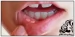 درمان آفت دهان با چند روش خانگی و گیاهی