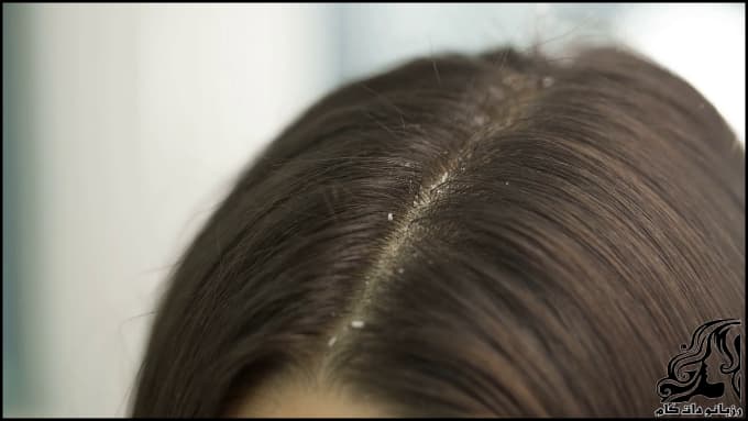 https://up.rozbano.com/view/3038501/Dandruff%20and%20itching%20of%20the%20head-02.jpg